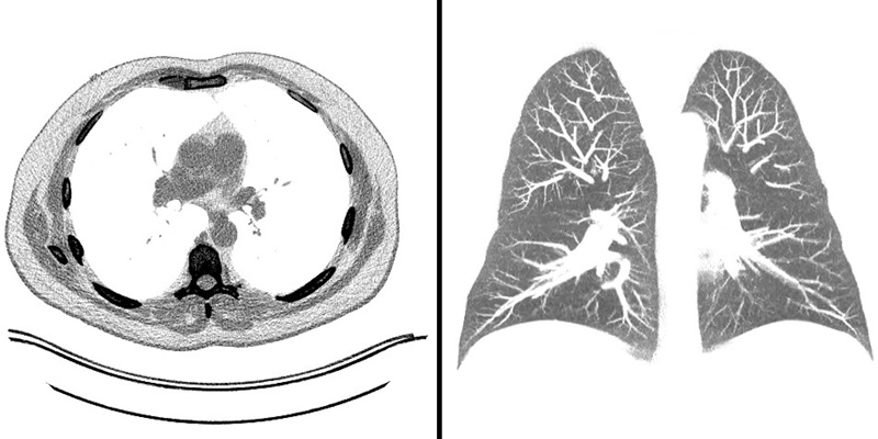 BH-LungCancerScreening-Image1